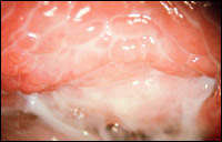 Осложнения гарднереллеза в уфе
