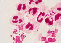 Гонококк - Neisseria gonorrhoeae, фото